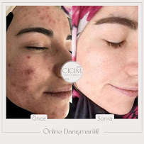 Cicim Güzellik Salonu cilt bakımı öncesi sonrası